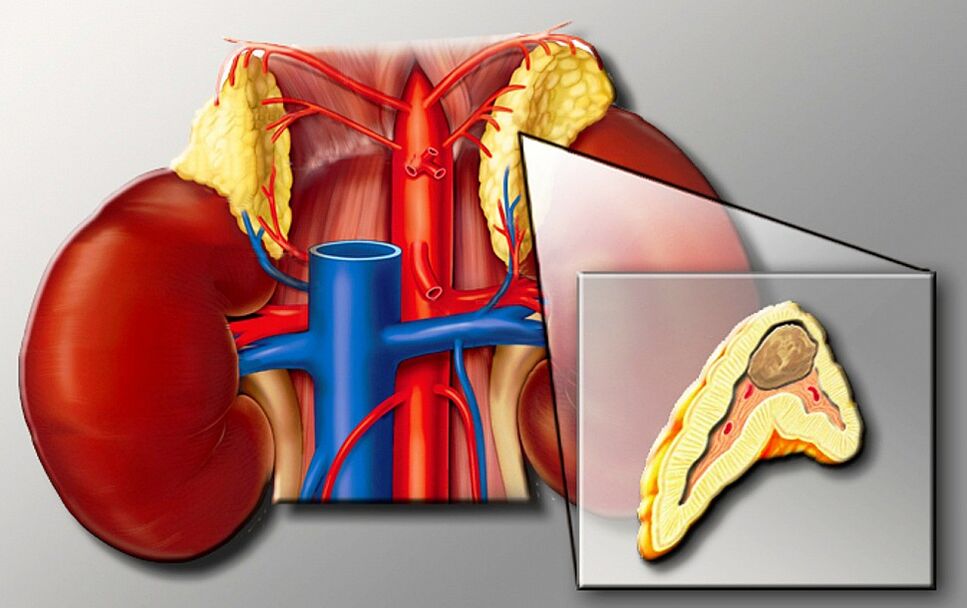 Feochromocitoma para hipertensión